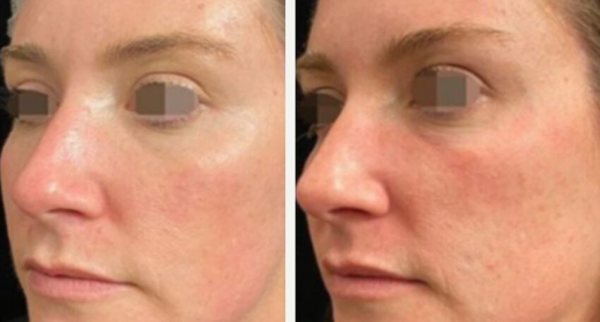 تجربتي مع بلازما الوجه