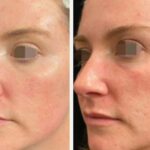 تجربتي مع بلازما الوجه