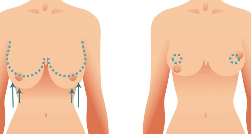 عمليات تصغير الثدي