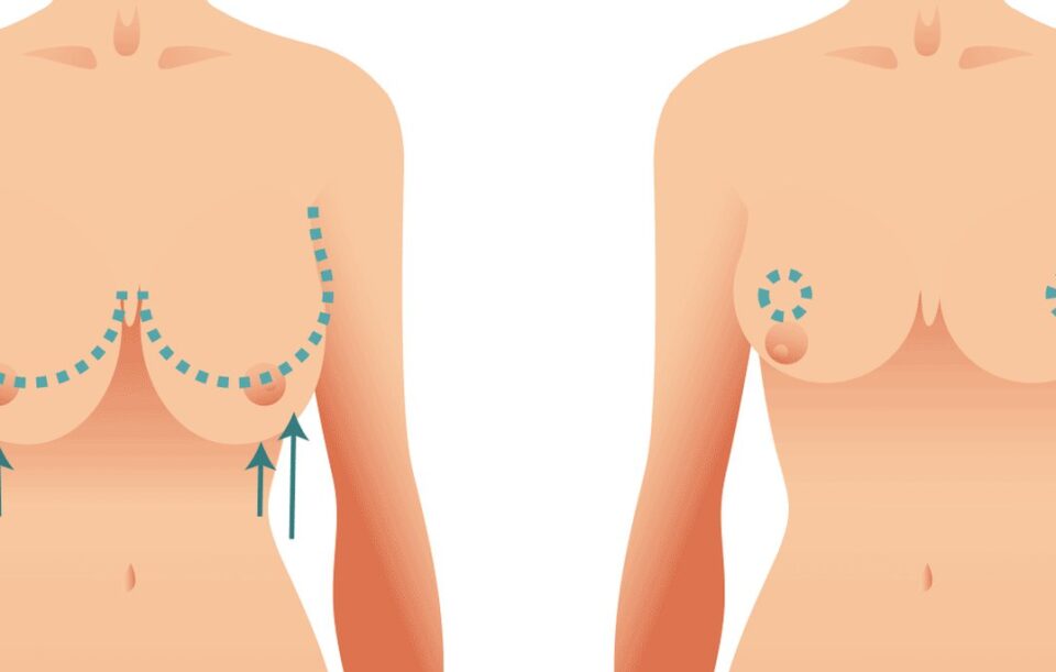 عمليات تصغير الثدي