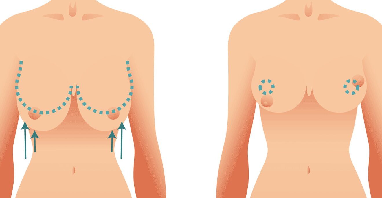 عمليات تصغير الثدي