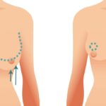 عمليات تصغير الثدي