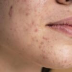 حبوب تحت الجلد