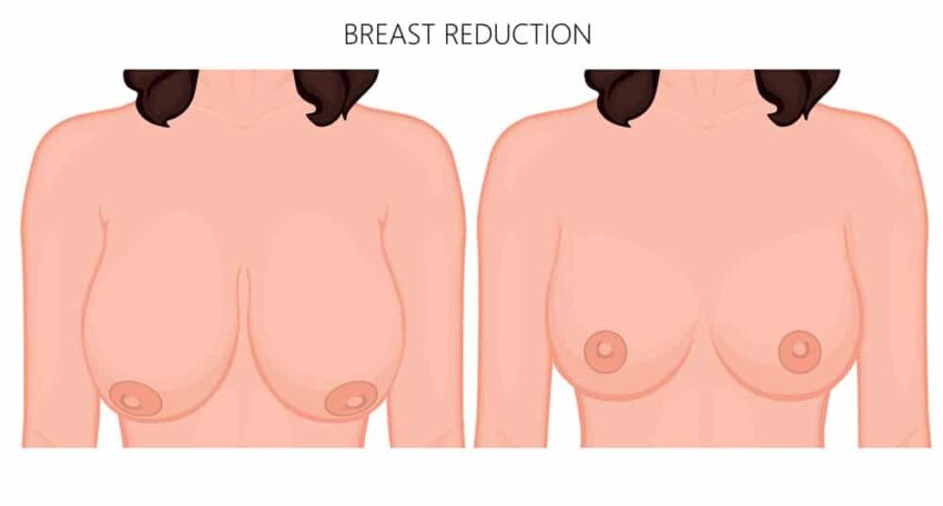 تصغير الثدي