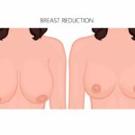 تصغير الثدي