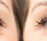 فيلر تحت العين