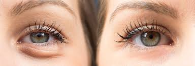        فيلر تحت العين 