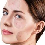 انواع حبوب الوجه