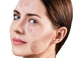 انواع حبوب الوجه