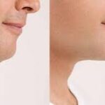 عملية شد الوجه