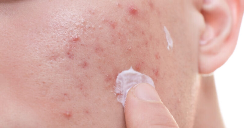 أفضل كبسولات لعلاج حب الشباب