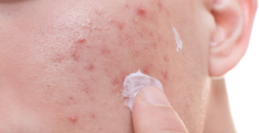 أفضل كبسولات لعلاج حب الشباب