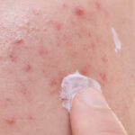 أفضل كبسولات لعلاج حب الشباب