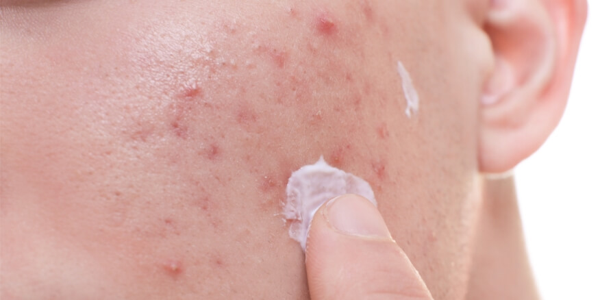 أفضل كبسولات لعلاج حب الشباب